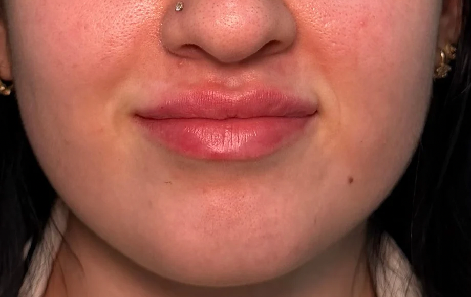 Lip definition, after treatment, selected work by Bissma Ayaz, RN