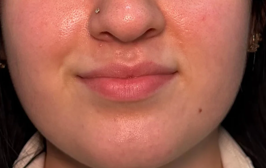 Lip definition, before treatment, selected work by Bissma Ayaz, RN