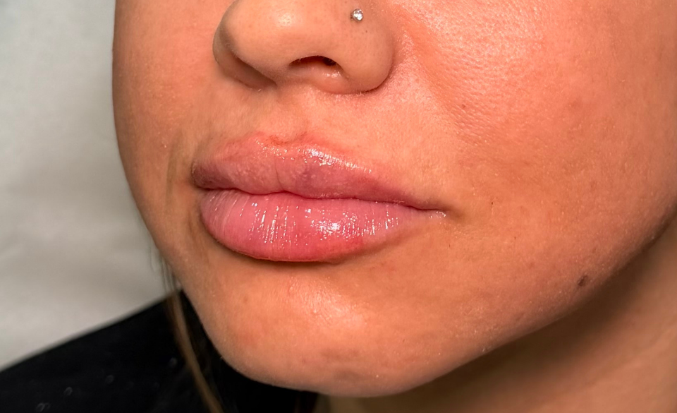 Lip profile, after treatment, selected work by Bissma Ayaz, RN