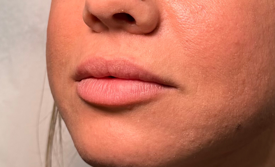 Lip profile, before treatment, selected work by Bissma Ayaz, RN