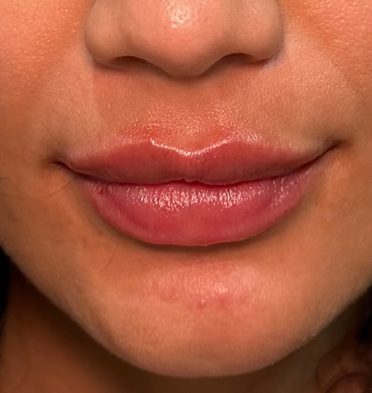 Lip volume, after treatment, selected work by Bissma Ayaz, RN