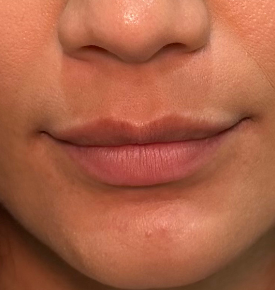 Lip volume, before treatment, selected work by Bissma Ayaz, RN