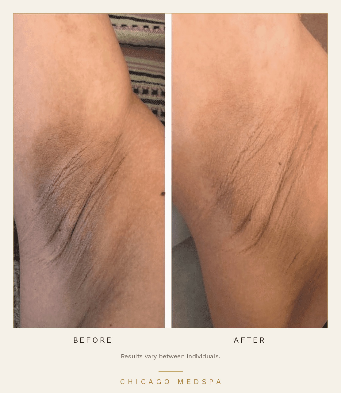 Consented before-and-after example of underarm laser hair reduction, with an individual-results disclaimer.