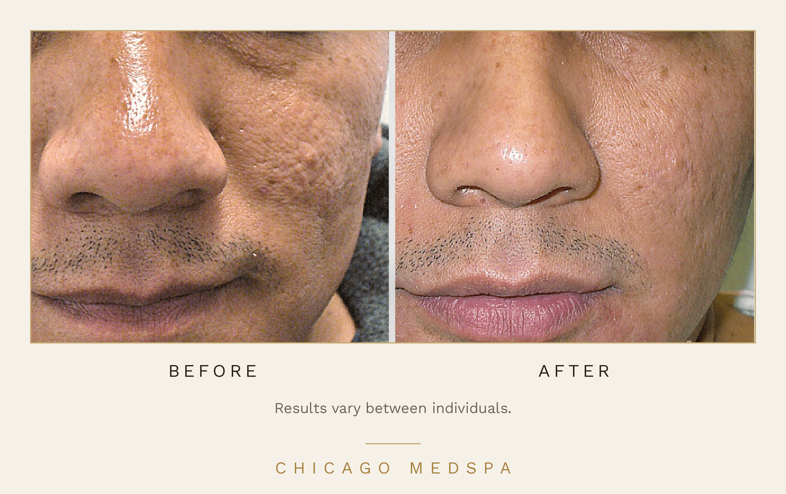 Consented before-and-after example of facial skin texture following microneedling, with an individual-results disclaimer.